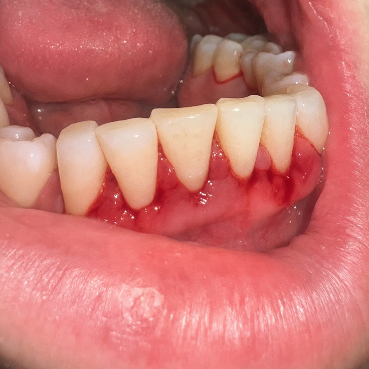 Heals gums